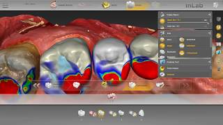 StepByStep Posterior Bridge Design Process [upl. by Ludmilla]