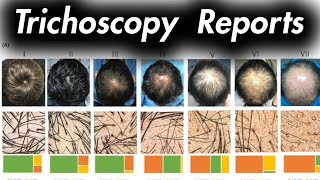 How to Predict Hair Loss  The Trichoscopy Report [upl. by Prosser]