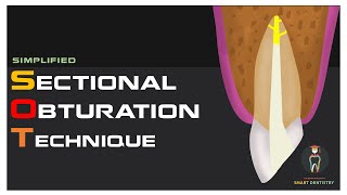 Simplified Sectional Obturation Technique [upl. by Cutlip890]