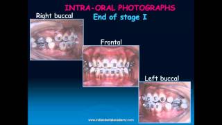 beggs technique part  orthodontic courses by Indian dental academy [upl. by Berthoud372]