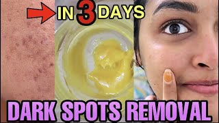 Remove DARK SPOTS NATURALLY in 3 Days 😍 Hyperpigmentation Acne Scars Brown Spots [upl. by Yelekreb]