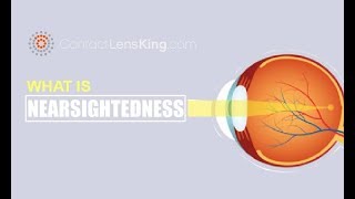 What is Nearsightedness What Causes Myopia [upl. by Llehcam429]