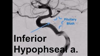 Beauty in Cerebral Angiogram A Prominent Inferior Hypophyseal Artery [upl. by Jahdal]