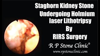 Staghorn Kidney Stone undergoing Holmium laser Lithotripsy [upl. by Cigam458]