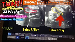 32 Weeks Twins  Boy  Boy  Both Male Fetus  Turtle 🐢 sign  Posterior Placenta  Ultrasound [upl. by Attekram]