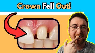 What to do if your Crown Falls out Dentist Explains [upl. by Noreen969]