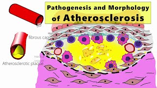 Atherosclerosis  Pathogenesis and Morphology  Learn by animation [upl. by Siuqramed726]