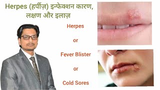 Herpes Infection of Skin  हर्पीज़ का कारण लक्षण और इलाज़ Herpes Symptoms Causes Treatment herpes [upl. by Chance]