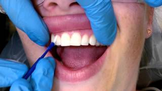 Fluoride varnish application demonstration [upl. by Arin]