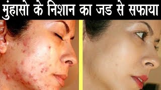 Remove Acne and Acne Scars from Root in 2 days How to get rid of acne scares in 2 Days [upl. by Ahsirpac]