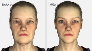 Facelift amp Neck Lift surgery  Dr Julian De Silva  3D medical animation [upl. by Ttiwed31]