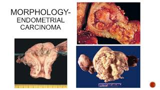 Diseases of the Vulva Vagina Cervix Uterus Part 2 [upl. by Chem]