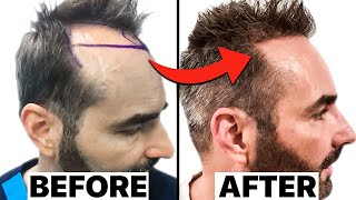 My SHOCKING 18 Months Hair Transplant Results  Surgeon Reacts [upl. by Nosneb]