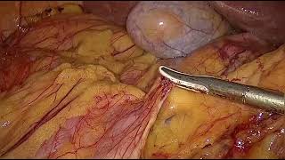 Laparoscopic assisted right hemicolectomy [upl. by Halland]