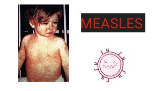 MEASLES Causes Pathology Symptoms Diagnosis Treatment Vaccination Care  What is Measles [upl. by Eibbil]