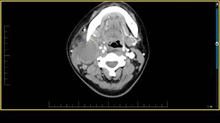 Salivary Glands  Mucoepidermoid Carcinoma [upl. by Jaquenetta]