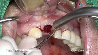 Extraction and immediate impant placement and GBR  Dr Kim Yongjin [upl. by Araeic]