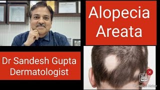 Alopecia areata को कैसे ठीक करें  9990804085 जानिए Dermatologist Dr Sandesh Gupta से। [upl. by Emylee]