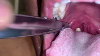 Large Tonsil Stone Removal [upl. by Alboran]