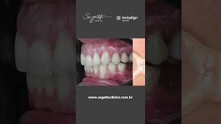 Caso de retratamento ortodôntico com Invisalign® [upl. by Hnoj]