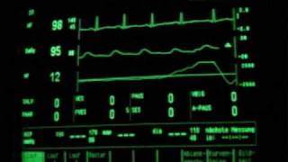 intensive care sleep EKG and SpO2 monitoring [upl. by Enitram]