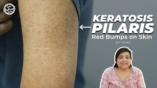 Keratosis Pilaris  Chicken Skin  How to treat Keratosis Pilaris Hindi  Dr Nivedita Dadu [upl. by Jerman375]