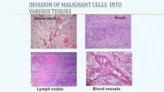 Squamous cell carcinoma and related lesions [upl. by Xineohp]