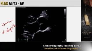 Lecture 3  Transthoracic Echocardiography Part 2 [upl. by Nnasor]