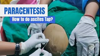 Paracentesis Procedure Ascites Tap in detail [upl. by Akelahs]