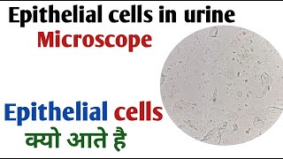 Causes of Epithelial Cells in Urine I Epithelial cells in urine [upl. by Corsiglia]