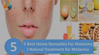 5 Best Home Remedies For Melasma I Natural Treatment for Melasma [upl. by Shanleigh]