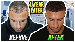 My Hair Transplant Results After 1 Year [upl. by Acsehcnarf]