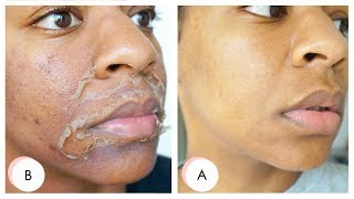 I GOT A CHEMICAL PEEL  Full Process  Results  Remove Dark Marks Enlarged Pores amp Wrinkles [upl. by Gemoets]