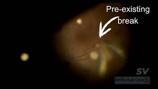 Vitrectomy for SLE Retinopathy [upl. by Accalia]