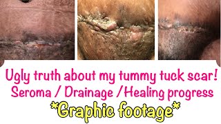 Why your tummy tuck scar is not healing  Seroma not healing  Healing process of tummy tuck scar [upl. by Anilecram]