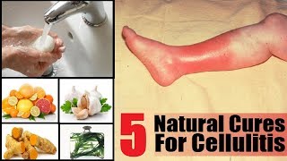 5 Home Remedies to Get Rid of Cellulitis Infection  By Top 5 [upl. by Aisatan]