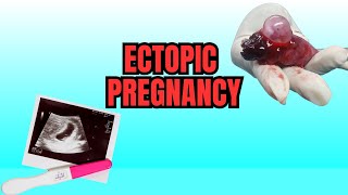 Ectopic Pregnancy  Causes Symptoms And Risks [upl. by Atarman]