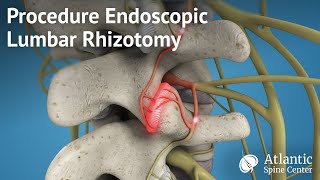 Procedure Endoscopic Lumbar Rhizotomy [upl. by Tammy]