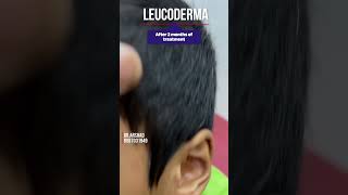 Best Leucoderma treatment in pune  सफ़ेद दाग का इलाज [upl. by Nylknarf]