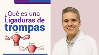 Qué es una ligadura de trompas l Dr Juan Luis Giraldo [upl. by Alodie]