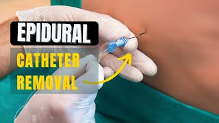 How to Remove Epidural Catheter safely [upl. by Ahilam]