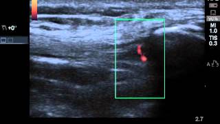 Infrapatellar Tendon Ultrasound [upl. by Kreis]