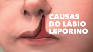 causas do lábio leporino [upl. by Straus]