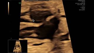 Ecocardiografía fetal Como evaluar el tabique interauricular [upl. by Uphemia]