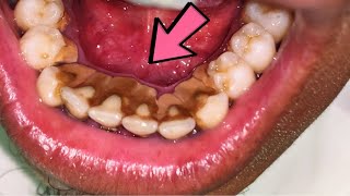 Brown Tartar  Scaling [upl. by Rosamund]