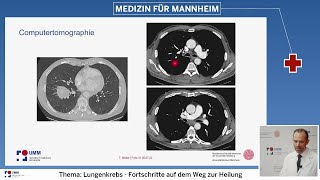 Vom Röntgenbild bis zur Therapie  moderne Diagnostik bei Lungenkrebs [upl. by Yllatan481]