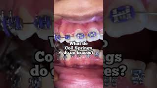 What do coil springs do on braces Tooth Time Family Dentistry New Braunfels [upl. by Nayt]