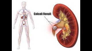 Soffri di calcoli renali Evita questi alimenti per non formare calcoli renaliVideo informativo [upl. by Faux]