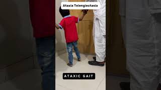 Ataxic Gait in Ataxia Telangiectasia ataxia telangiectasia cerebellar [upl. by Salokkin713]