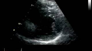 ACUTE CORONARY SYNDROME  HYPOKINESIA [upl. by Ahtera]